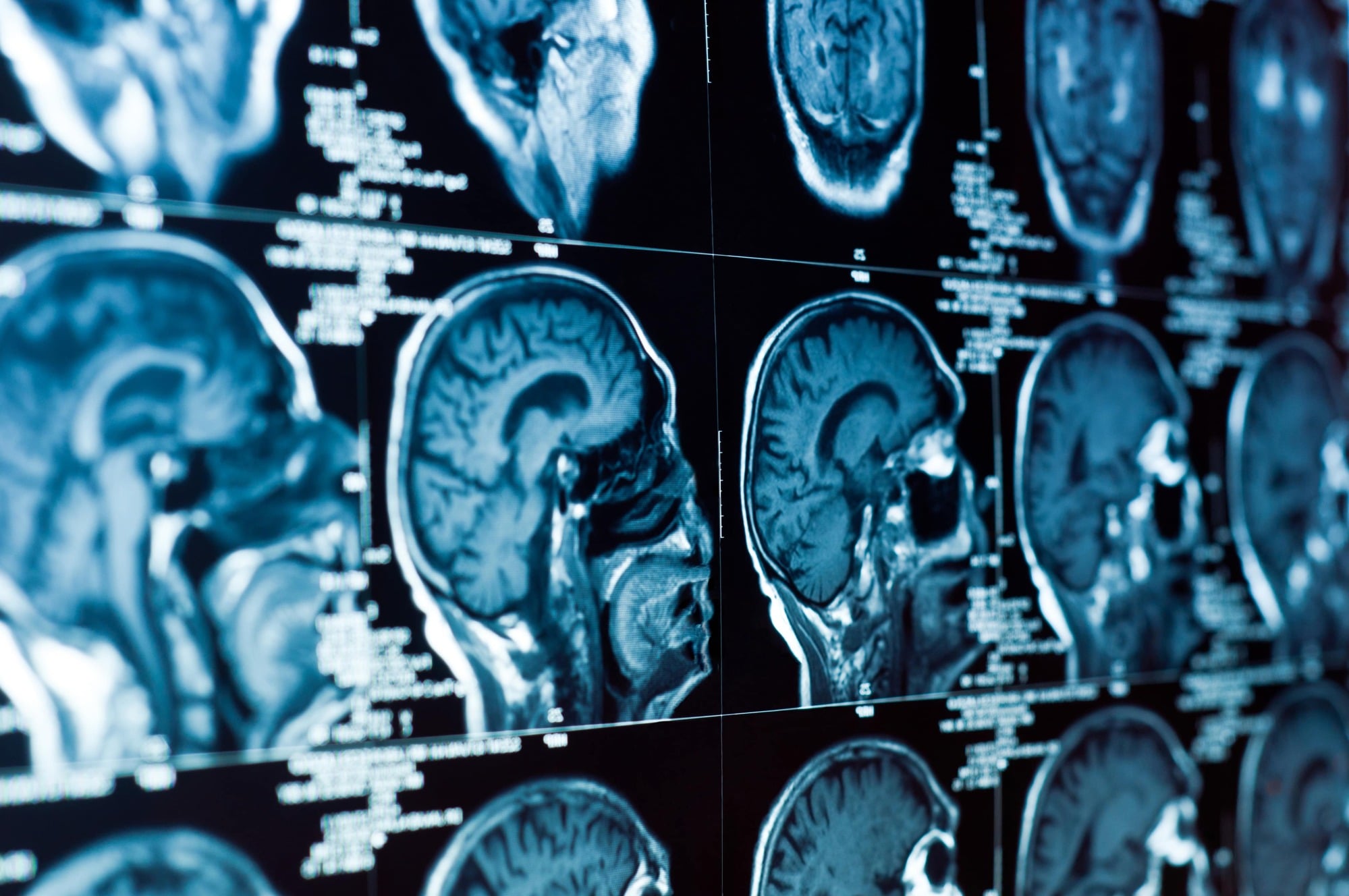 Pasadena, TX brain injury attorney